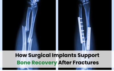 How Surgical Implants Support Bone Recovery After Fractures
