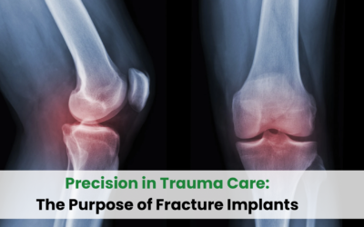 Precision in Trauma Care: The Purpose of Fracture Implants