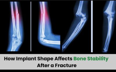 How Implant Shape Affects Bone Stability After a Fracture