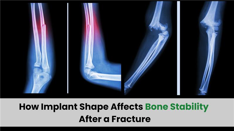 How Implant Shape Affects Bone Stability After a Fracture