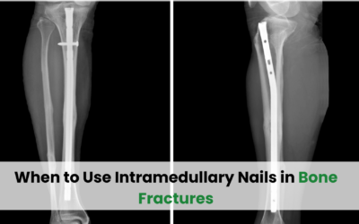 When to Use Intramedullary Nails in Bone Fractures