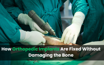 How Orthopedic Implants Are Fixed Without Damaging the Bone
