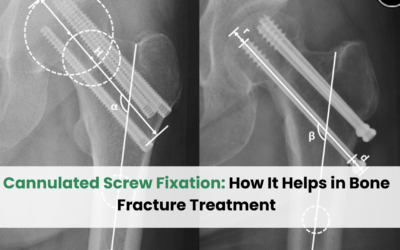 Cannulated Screw Fixation: How It Helps in Bone Fracture Treatment