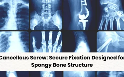 Cancellous Screw: Secure Fixation Designed for Spongy Bone Structure