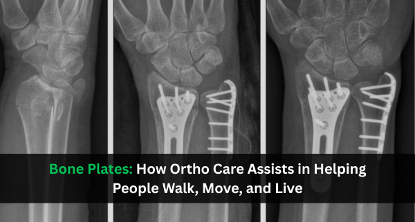 Bone plates for orthopedic fracture fixation