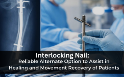 Interlocking Nail: Reliable Alternate Option to Assist in Healing and Movement Recovery of Patients