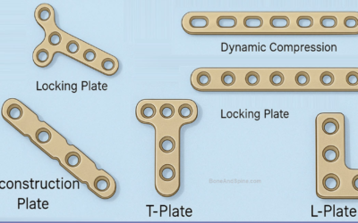 When to Use a Locking T-Fix T-Plate: Techniques for Metaphyseal Fracture Management