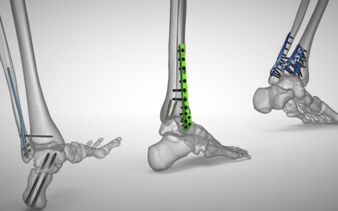 Why Orthopedic Manufacturer in India Is Becoming a Global Hub for Implant Production