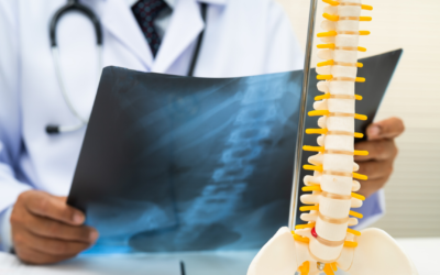 The Evolution of Bone Plates: How Pre-Contoured Designs Are Improving Trauma Surgery