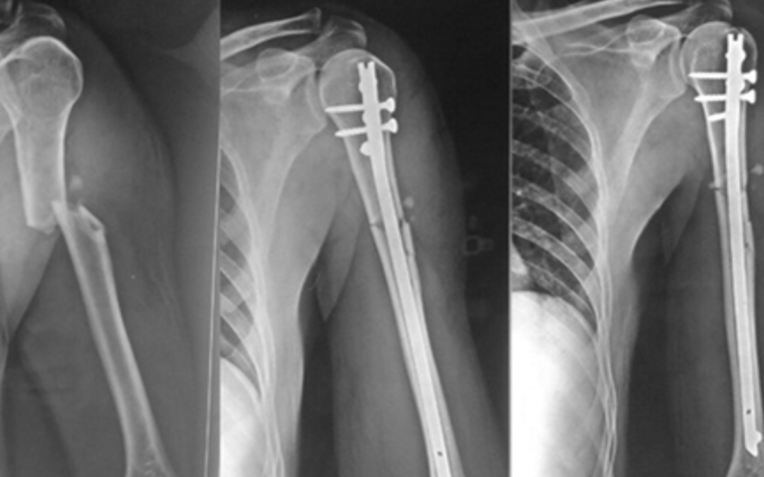 Understanding Interlocking Nail Systems: A Guide to Modern Intramedullary Fixation