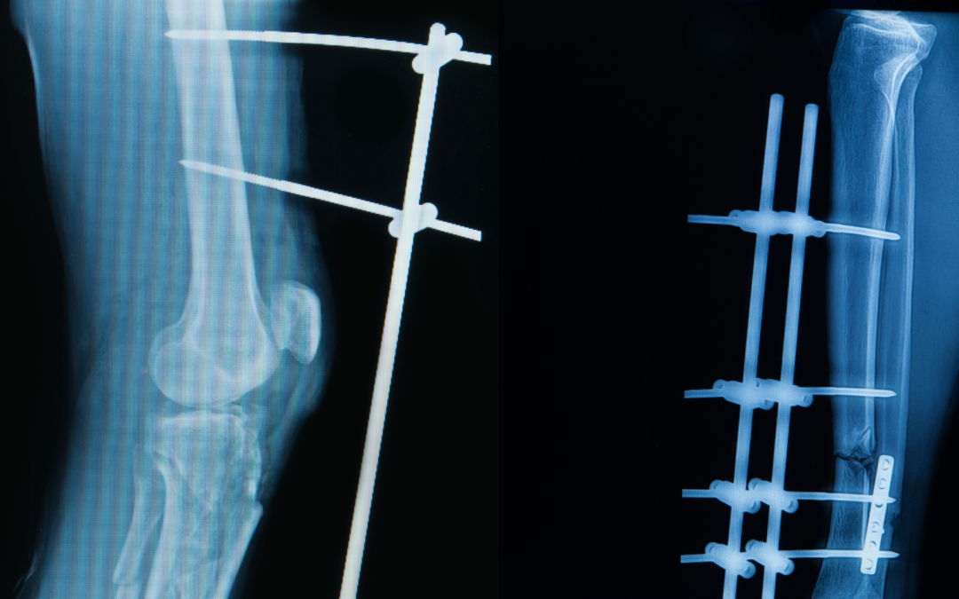 Managing Femoral Fractures with Steinmann Pin Traction in Emergency Settings