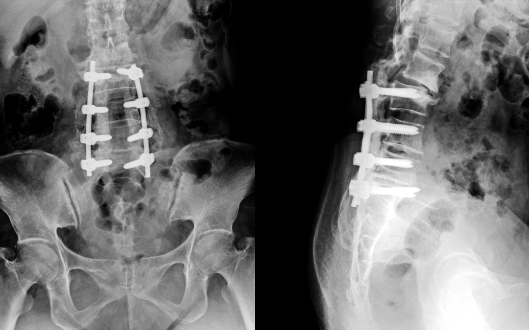 Proximal Femoral Locking Plate: Best Practices for Intertrochanteric and Subtrochanteric Fractures